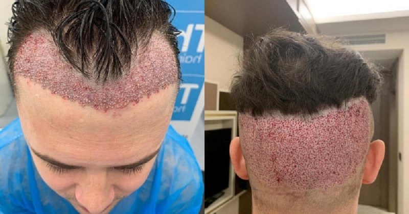 Cấy tóc không đúng kỹ thuật có thể gây tổn thương nang tóc