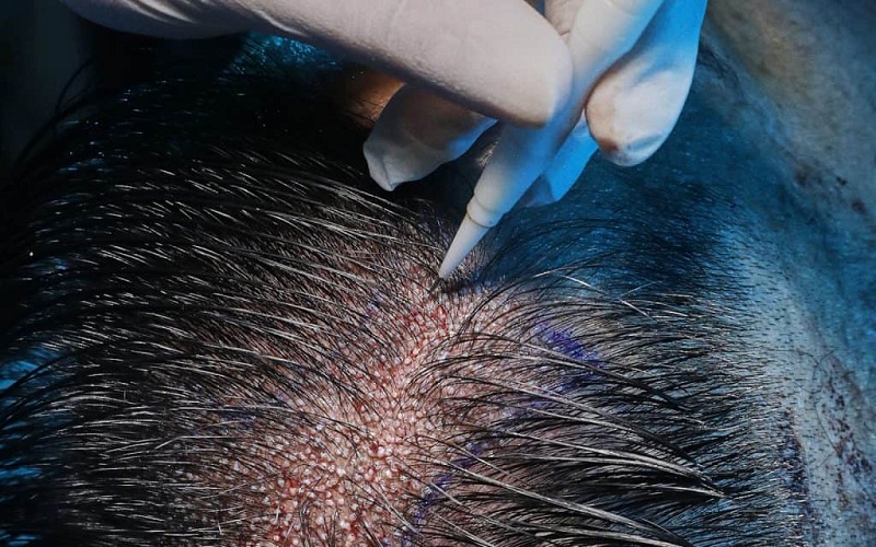 Cấy tóc giúp khắc phục tình trạng hói đầu