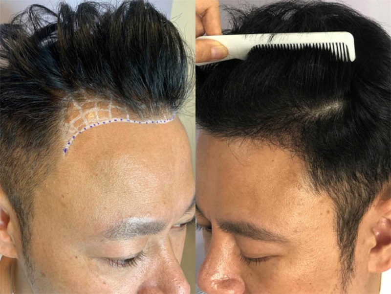 Nên lựa chọn địa chỉ cấy tóc uy tín
