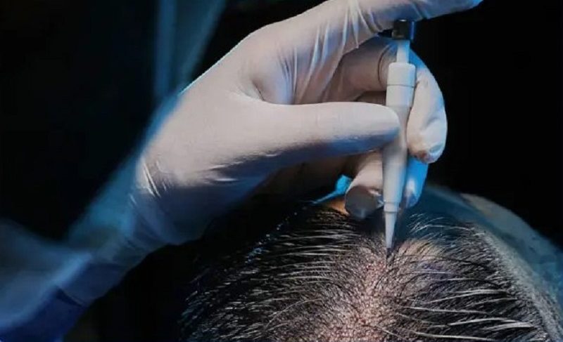 Bác sĩ thao tác cấy tóc chuẩn y khoa