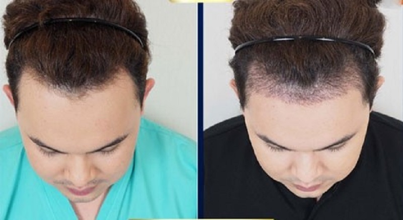 Khách hàng sau khi cấy tóc tại Kangnam đạt kết quả tự nhiên