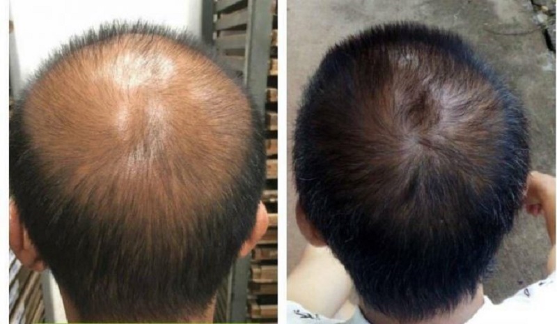 Nang tóc mới phát triển, giúp khắc phục tình trạng hói đầu