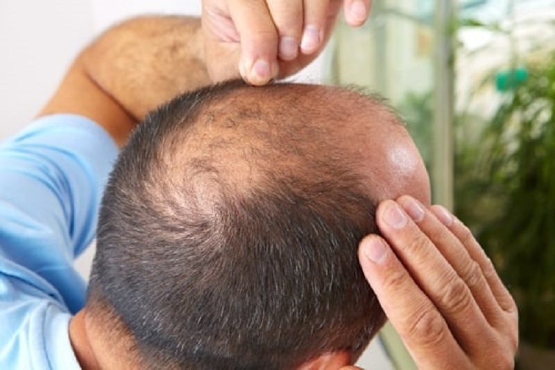 Vùng tóc sinh học bị rụng không thể mọc lại