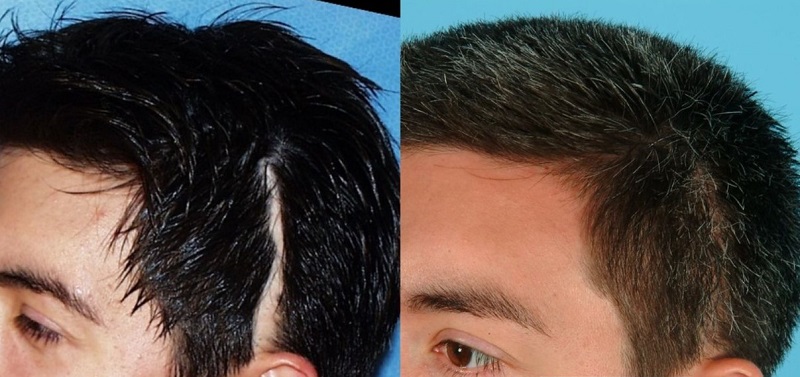 Diện tích sẹo vùng đầu có ảnh hưởng đến chi phí