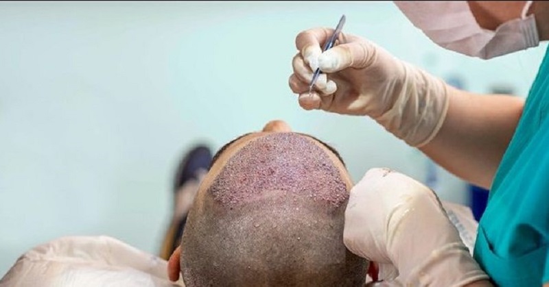 Kỹ thuật cấy tóc ảnh hưởng đến chi phí thực hiện