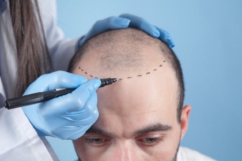 Số lượng tóc cần cấy ảnh hưởng đến chi phí thực hiện