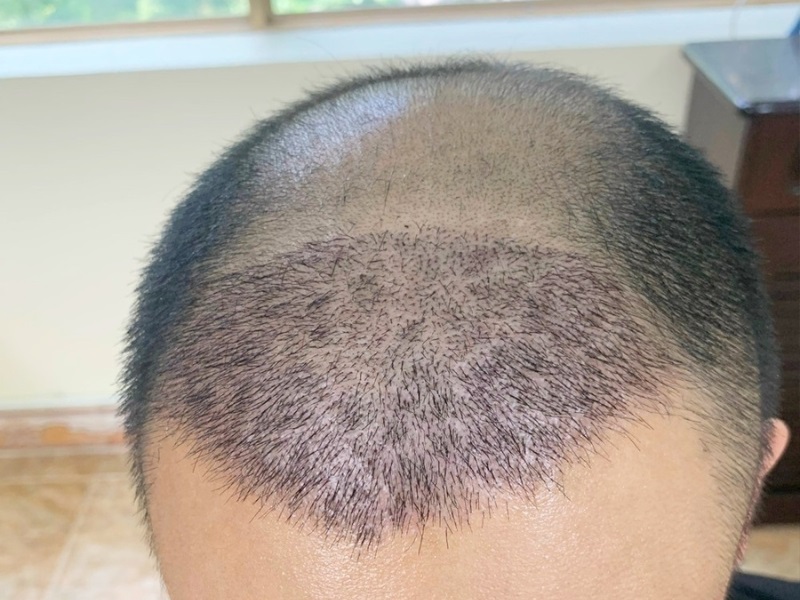 Thực hiện cấy tóc tại địa chỉ uy tín sẽ giúp đảm bảo kết quả tốt nhất