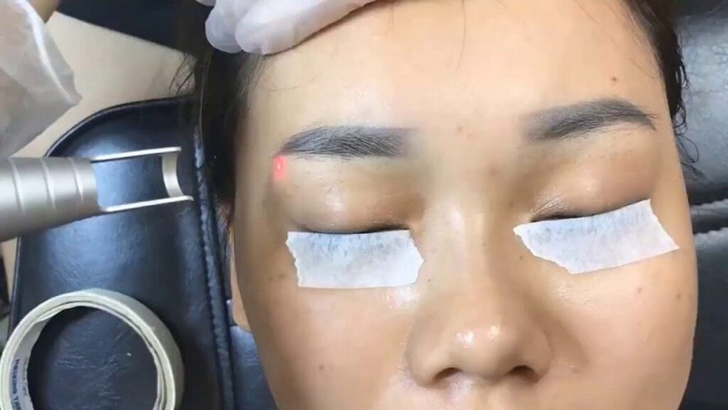 Phương pháp laser được sử dụng để xóa chân mày cũ