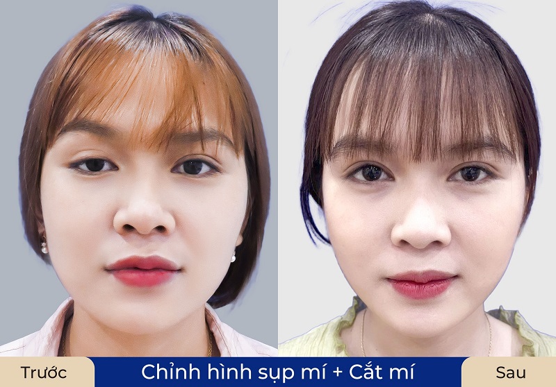 Chỉnh hình sụp mí và cắt mí mang lại hiệu quả nhanh, lâu dài