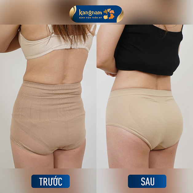 Thành quả sau phẫu thuật nâng mông bằng túi độn
