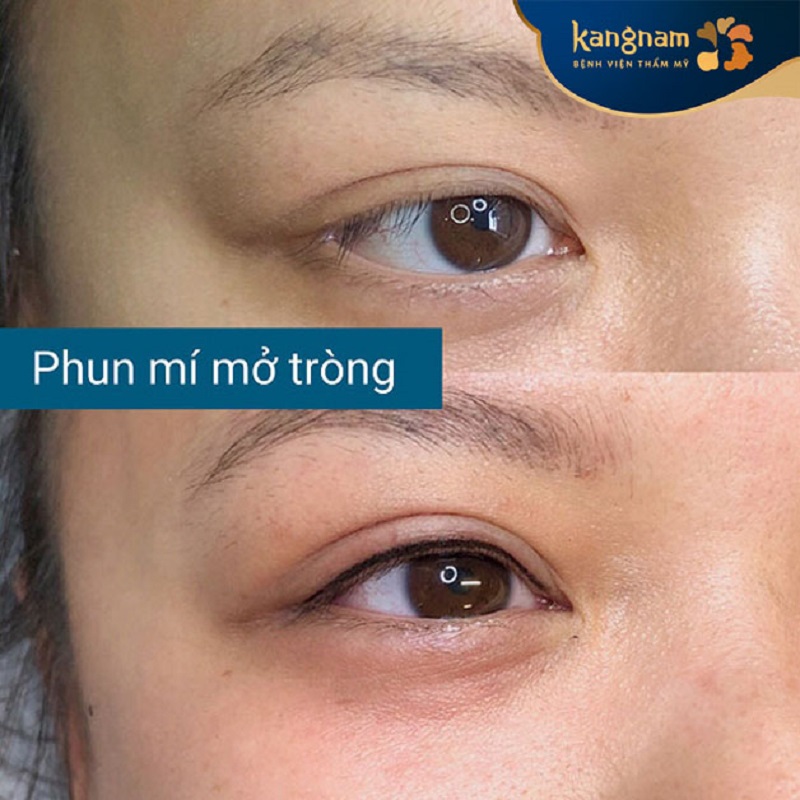 Kangnam ứng dụng phun mí mở tròng chất lượng cao