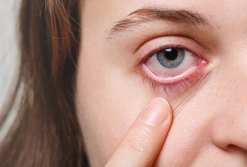 Vùng phun mí mắt sưng ngứa, nhiễm trùng