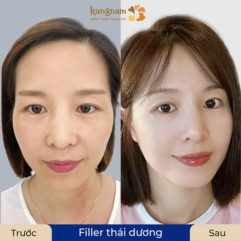 Khách hàng trẻ hơn đến 10 tuổi sau khi tiêm filler thái dương