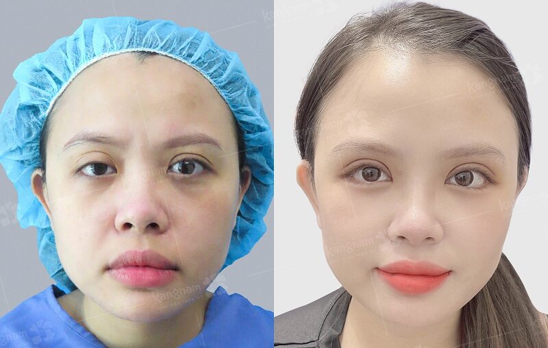 Mí của khách hàng được cắt lại để đảm bảo sự cân đối
