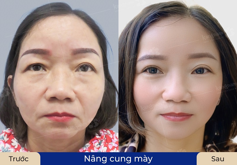 Gương mặt tươi trẻ, rạng rỡ sau nâng cung mày