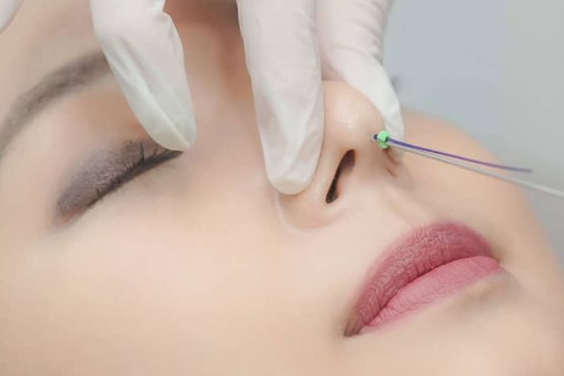 Người có bệnh nền không nên nâng mũi bằng chỉ