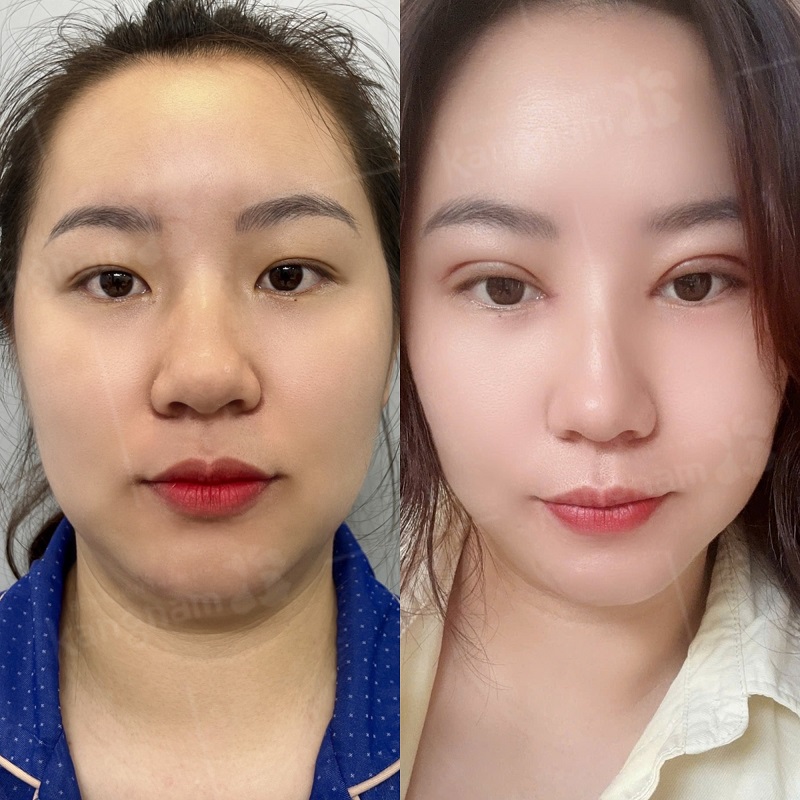 Kangnam là cơ sở cắt mí được nhiều khách hàng lựa chọn