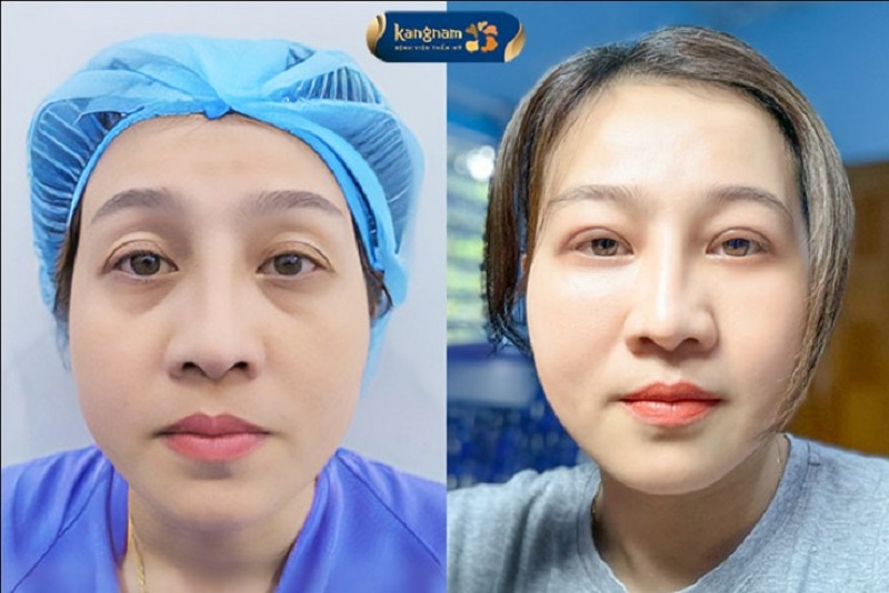 Đôi mắt tươi sáng và khắc phục được tình trạng bọng mỡ dư thừa