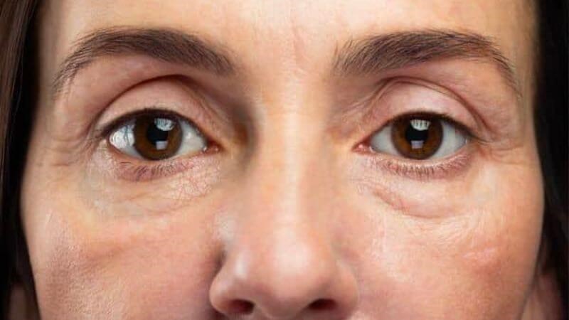 Quá trình lão hóa khiến bọng mắt bị hõm sâu