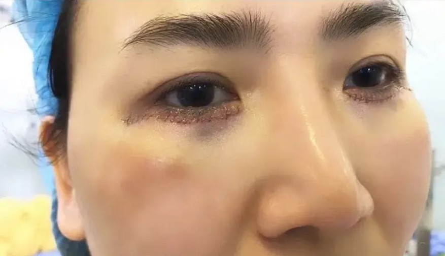 Cắt mí mắt dưới không đúng cách có thể khiến bọng mắt bị hõm