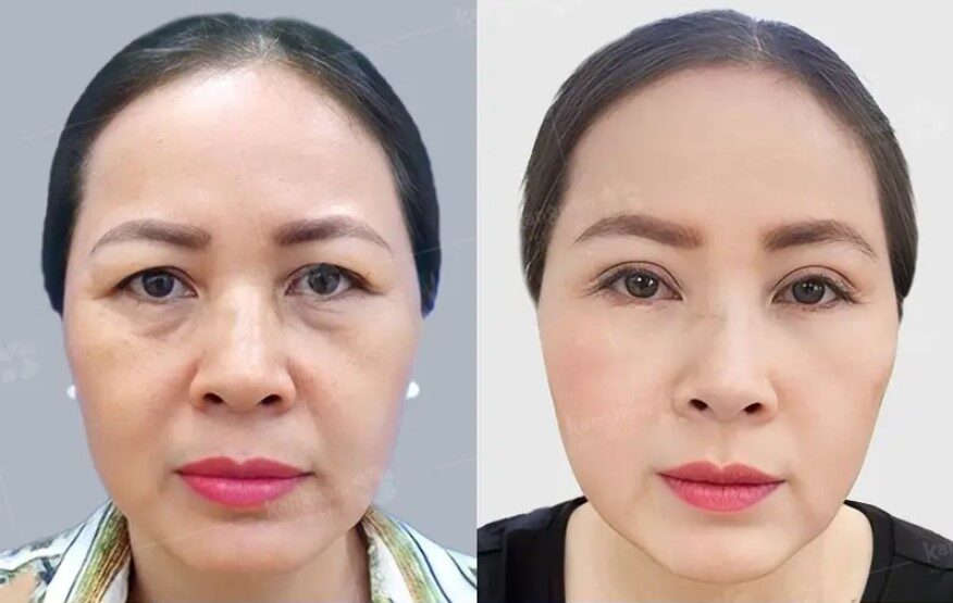 Phương pháp cắt mí có thể khắc phục được khuyết điểm vùng mí mắt dưới