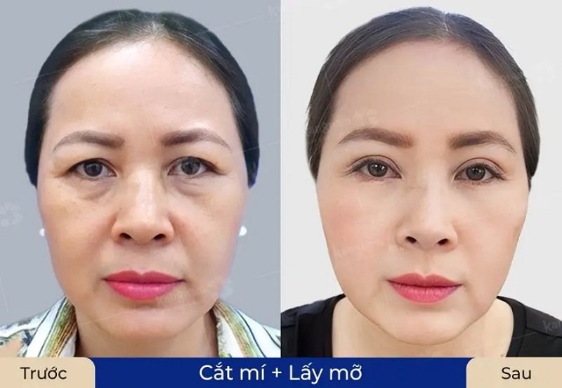 Cắt mí và lấy mỡ bọng mắt giúp gương mặt tươi trẻ hơn
