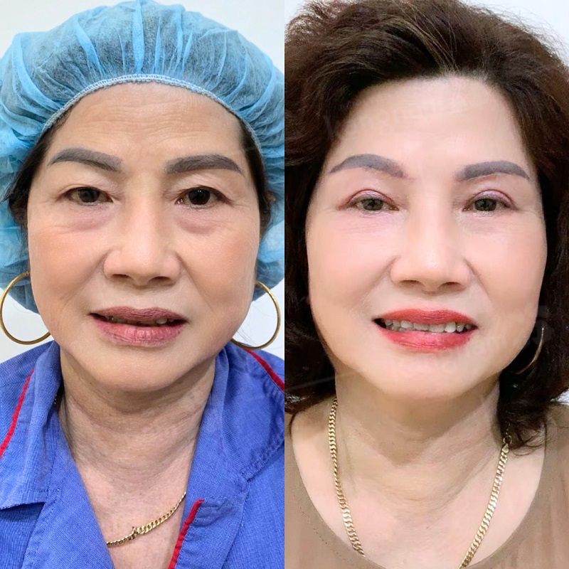 Đôi mắt tươi trẻ, cân đối hơn sau lấy mỡ mí mắt và cắt mí