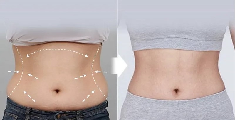 Những người có nhiều da dư sau giảm cân có thể thực hiện