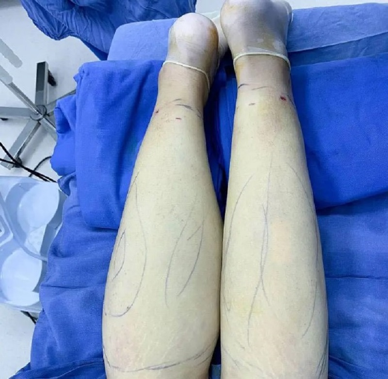 Đôi chân được thon gon, cân đối hơn