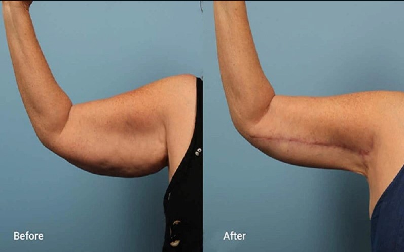 Cắt nhiều da cánh tay tăng nguy cơ gây ra nhiều biến chứng