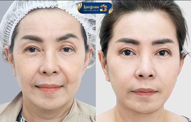 Cắt da cổ giúp vùng da săn chắc, có độ đàn hồi tốt hơn