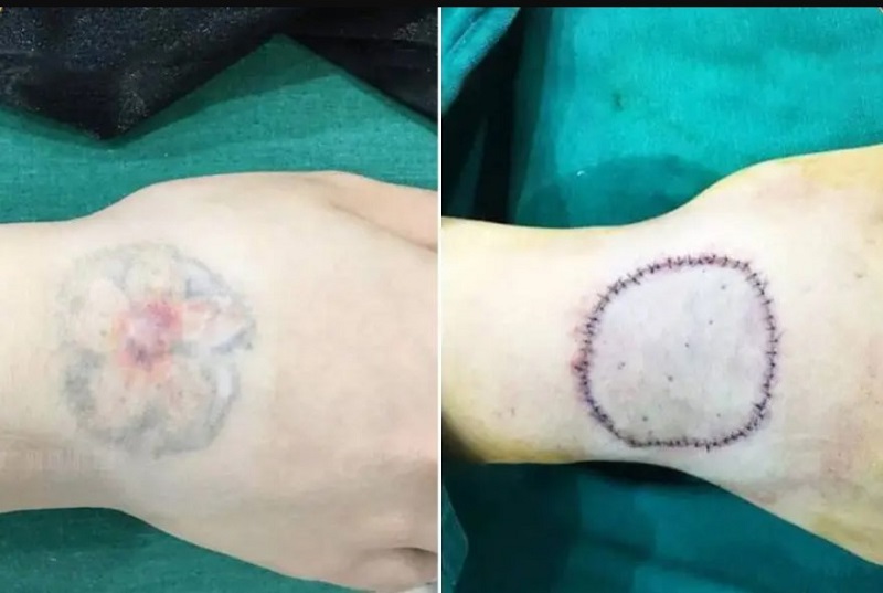 Cắt da hình xăm có thể thực hiện được với những vùng diện tích nhỏ