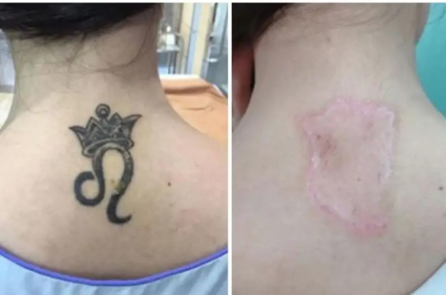 Hình xăm có thể được loại bỏ hiệu quả
