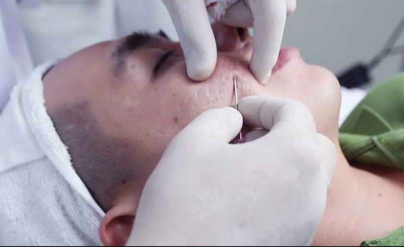 Cắt da sẹo giúp khắc phục tình trạng sẹo lõm