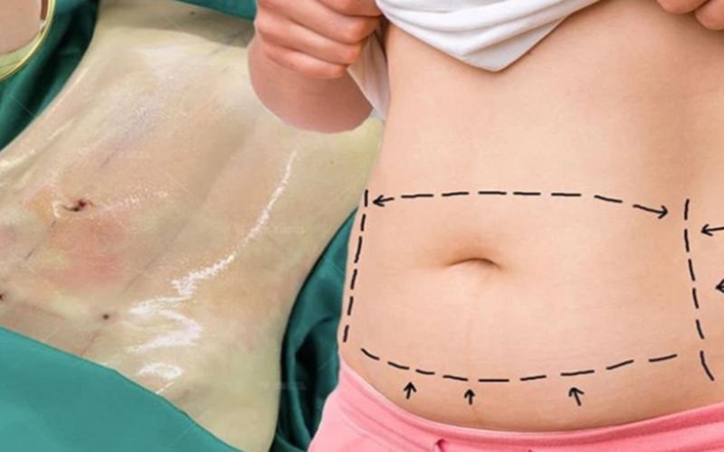Việc loại bỏ da thừa cần được thực hiện tại cơ sở thẩm mỹ uy tín