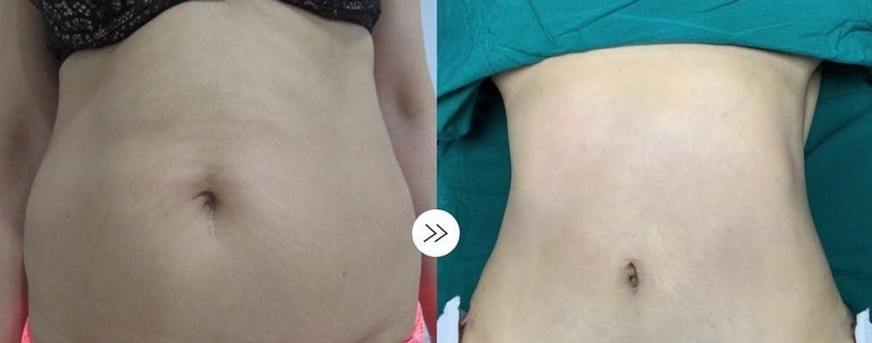 Cắt da thừa sẽ có sự khác nhau tùy thuộc vào vị trí thực hiện