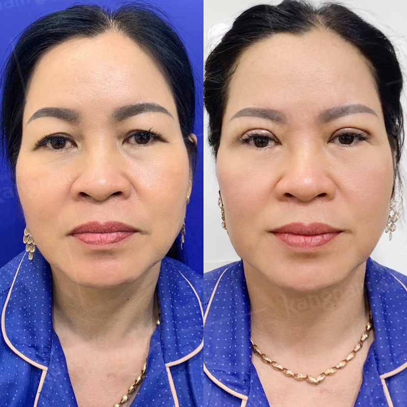 Cắt da thừa vùng mí mắt sẽ có giá thấp hơn
