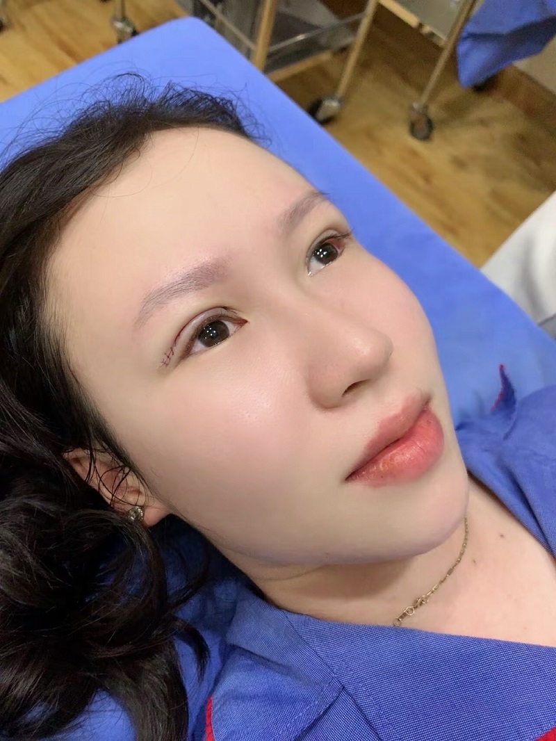 Ăn xoài sẽ hỗ trợ nếp mí nhanh phục hồi