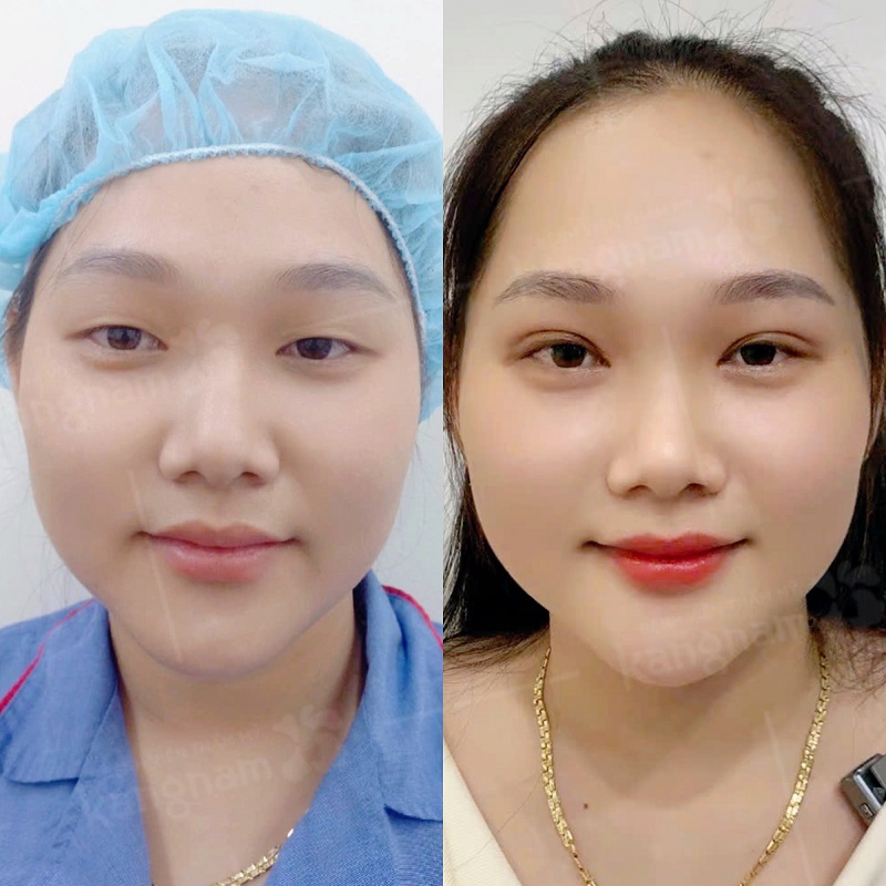 Cắt mí tại Bệnh viện Thẩm mỹ Kangnam mang lại đôi mắt cân đối, hài hòa