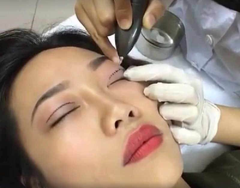 Cắt mí laser sủ dụng tia laser để tạo nếp mí
