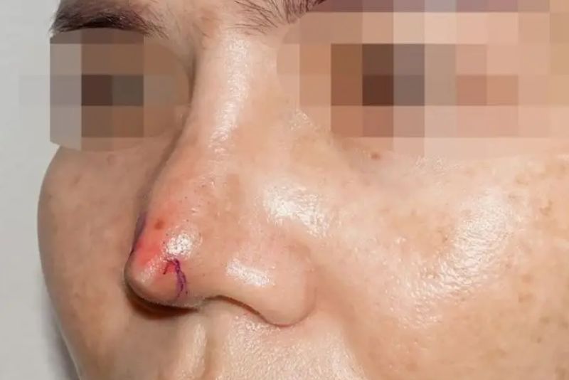 Cấu trúc mũi yếu có thể là nguyên nhân khiến mũi hỏng sau phẫu thuật