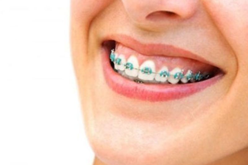 Niềng răng kết hợp chỉnh lợi