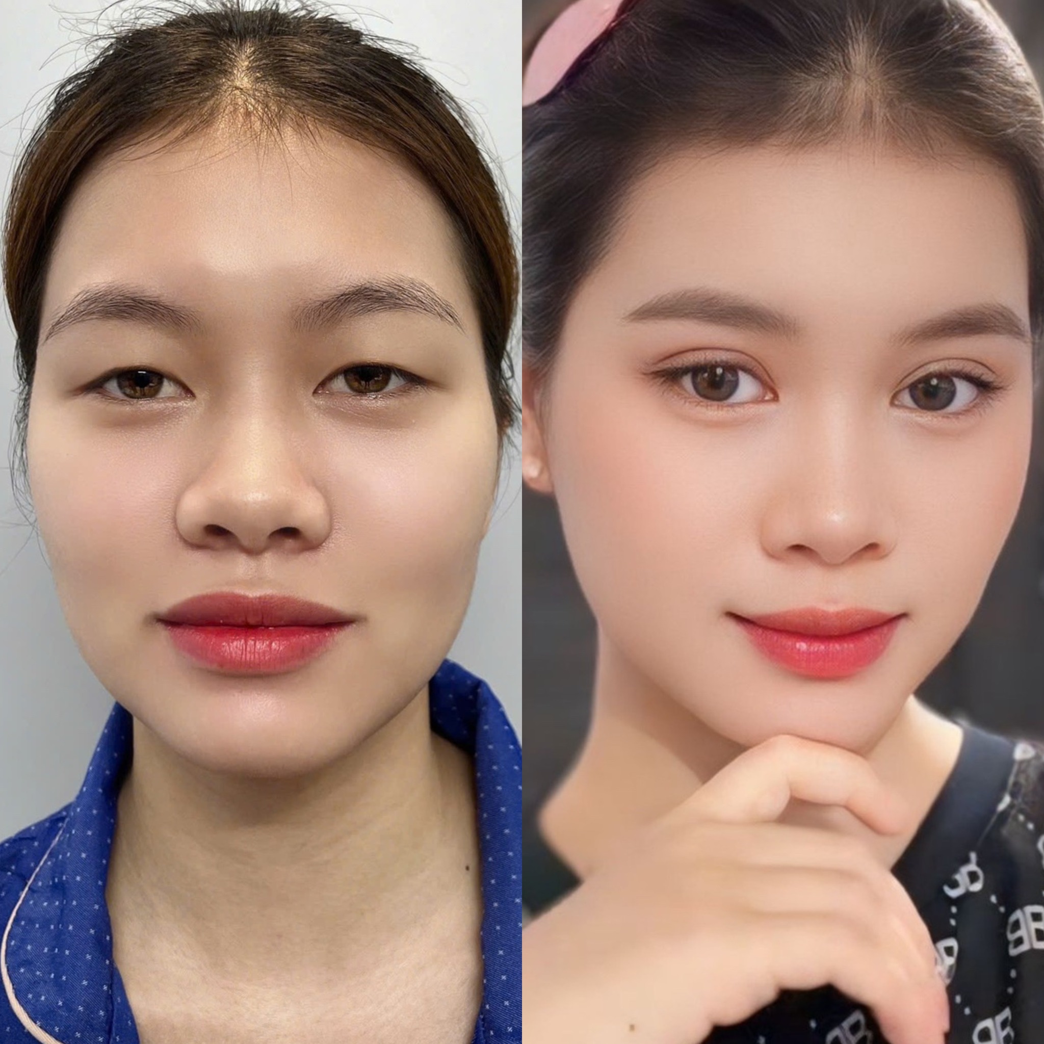 Hình ảnh trước cắt mí Diệu Yến gặp tình trạng mí lót, sau khi thực hiện tại Kangnam chỉ 7 ngày nếp mí đã vào form, cân đối và tự nhiên