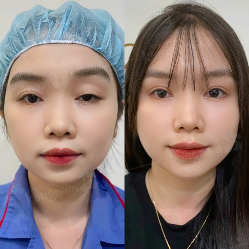 Nếp mí mới ổn định và cân đối