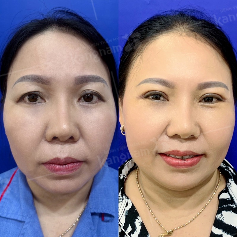 Sau cắt mí giúp chị em cải thiện được tầm nhìn