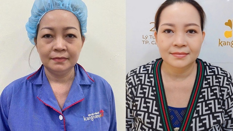 Vết thương ổn định, chân mày cân đối và hài hòa