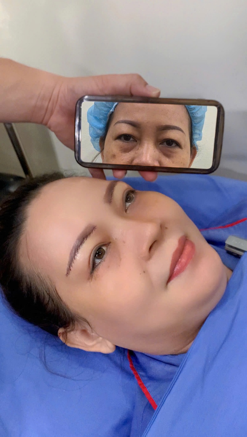 Sau khoảng 7 ngày khách hàng có thể cắt chỉ cung chân mày