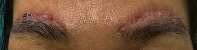 Phẫu thuật để khắc phục sẹo lồi