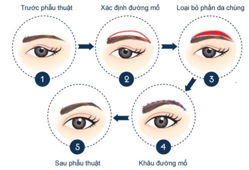 Nâng cung chân mày có tác dụng loại bỏ da chùng