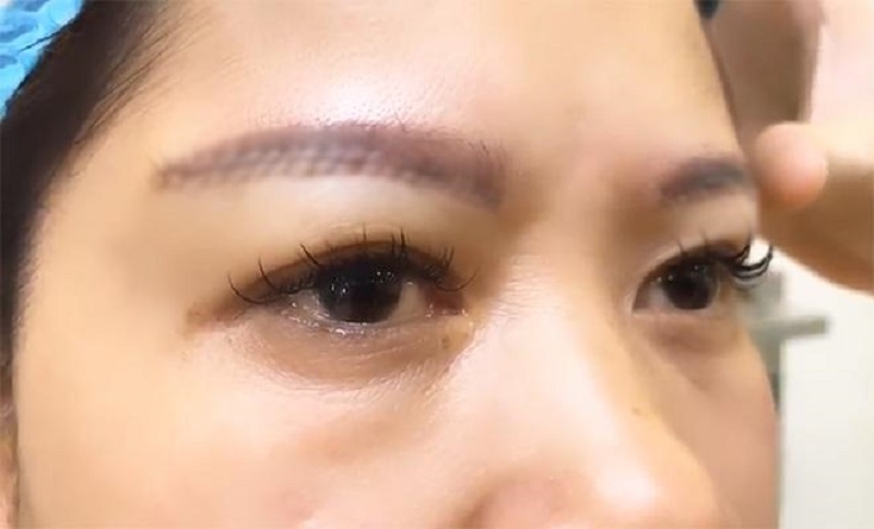 Nếu không nâng cung chân mày tại cơ sở thẩm mỹ uy tín sẽ gây ra nhiều biến chứng